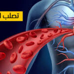 تصلّب الشرايين